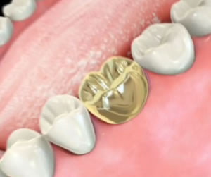 Link to more info about Gold Crowns