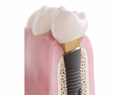 Choosing a Professional for Your Dental Implants in Baltimore