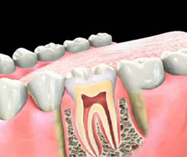 Do You Need a Root Canal Procedure?