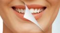 Regaining Your Confidence through Teeth Whitening
