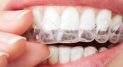 Invisalign: Straightening Teeth Without Braces